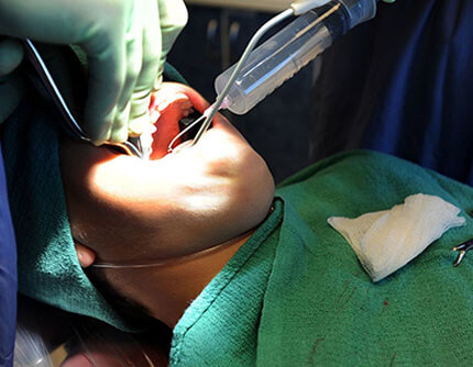 TOOTH EXTRACTION