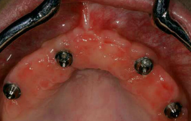 IMPLANT RETAINED PROSTHESIS