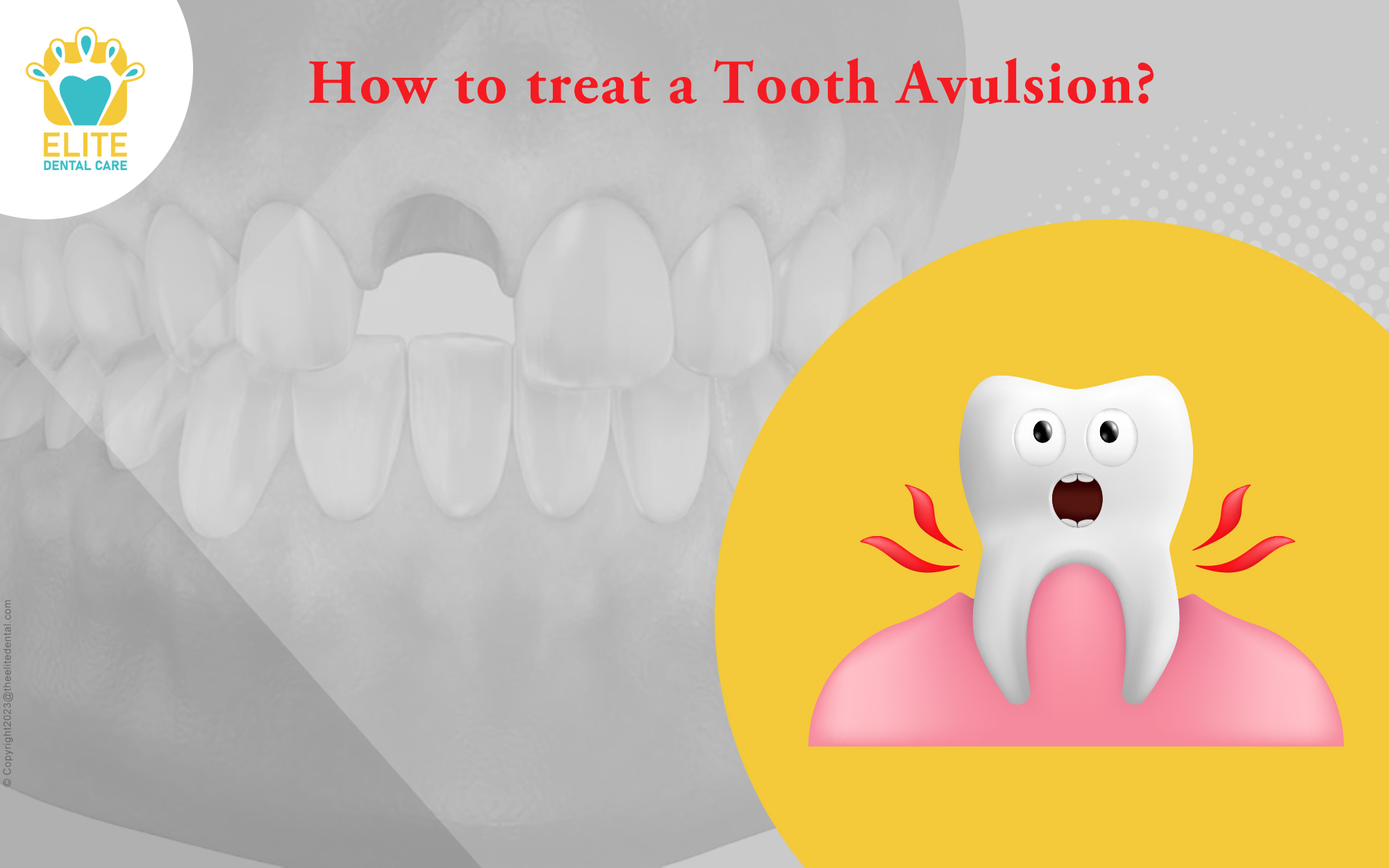 HOW TO TREAT A TOOTH AVULSION