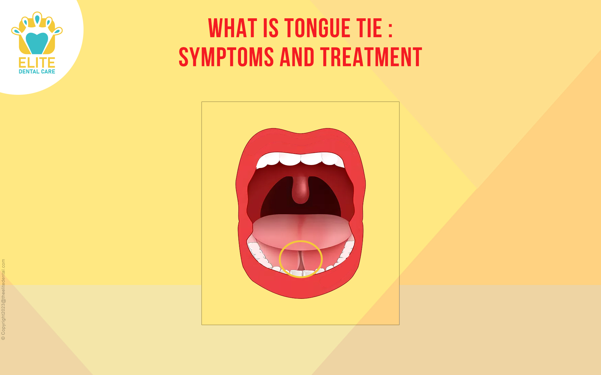 what is tongue tie - symptoms and treatment