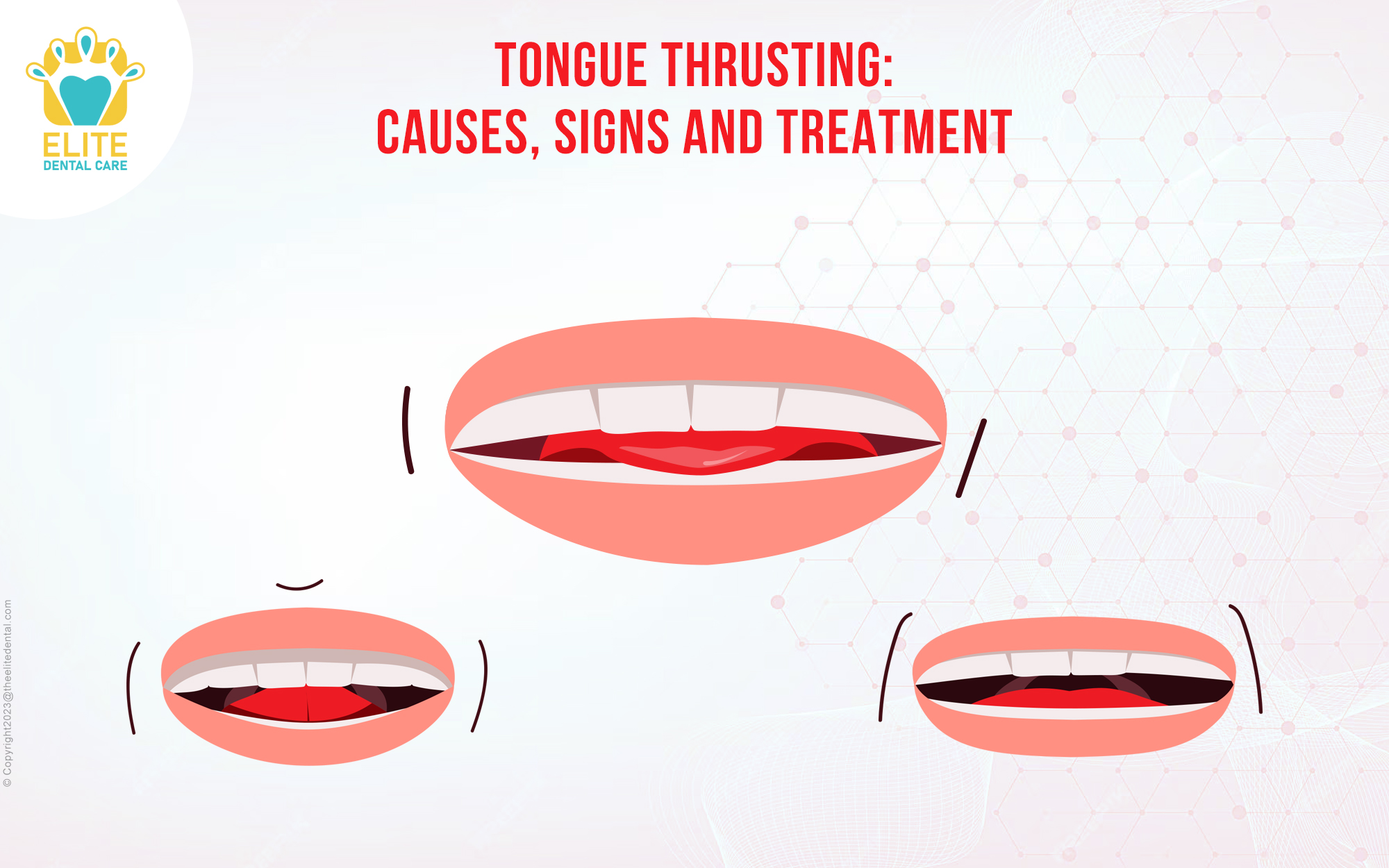 tongue thrusting - causes, signs and treatment
