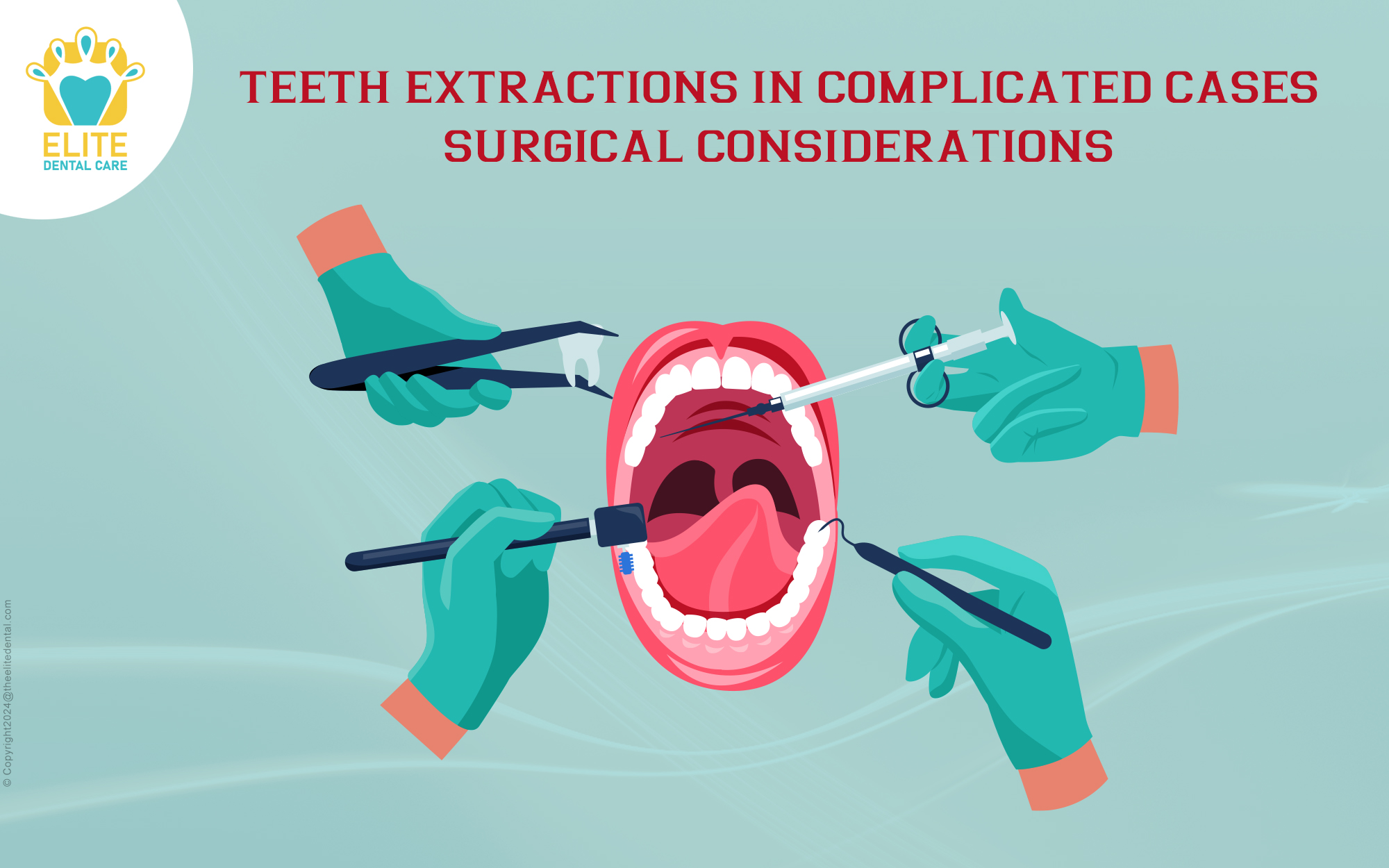 Teeth Extractions in Complicated Cases: Surgical Considerations