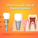 The Pros and Cons of dental Implants