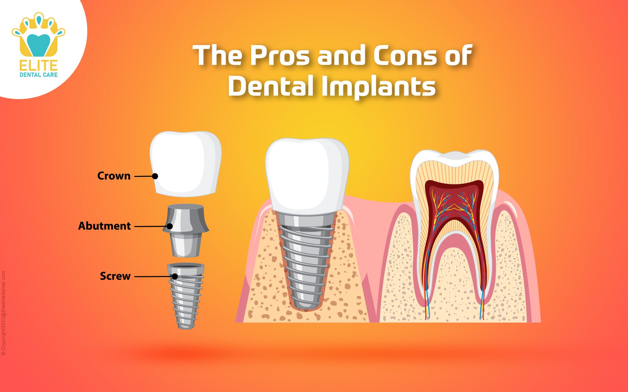 pro and cons of dental implants
