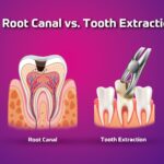 Root Canal vs. Tooth Extraction