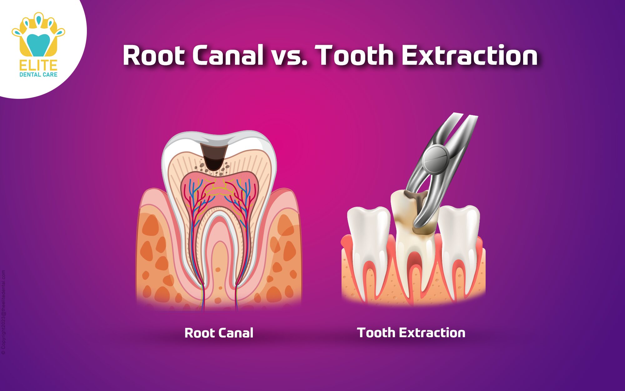 root canal vs tooth extraction