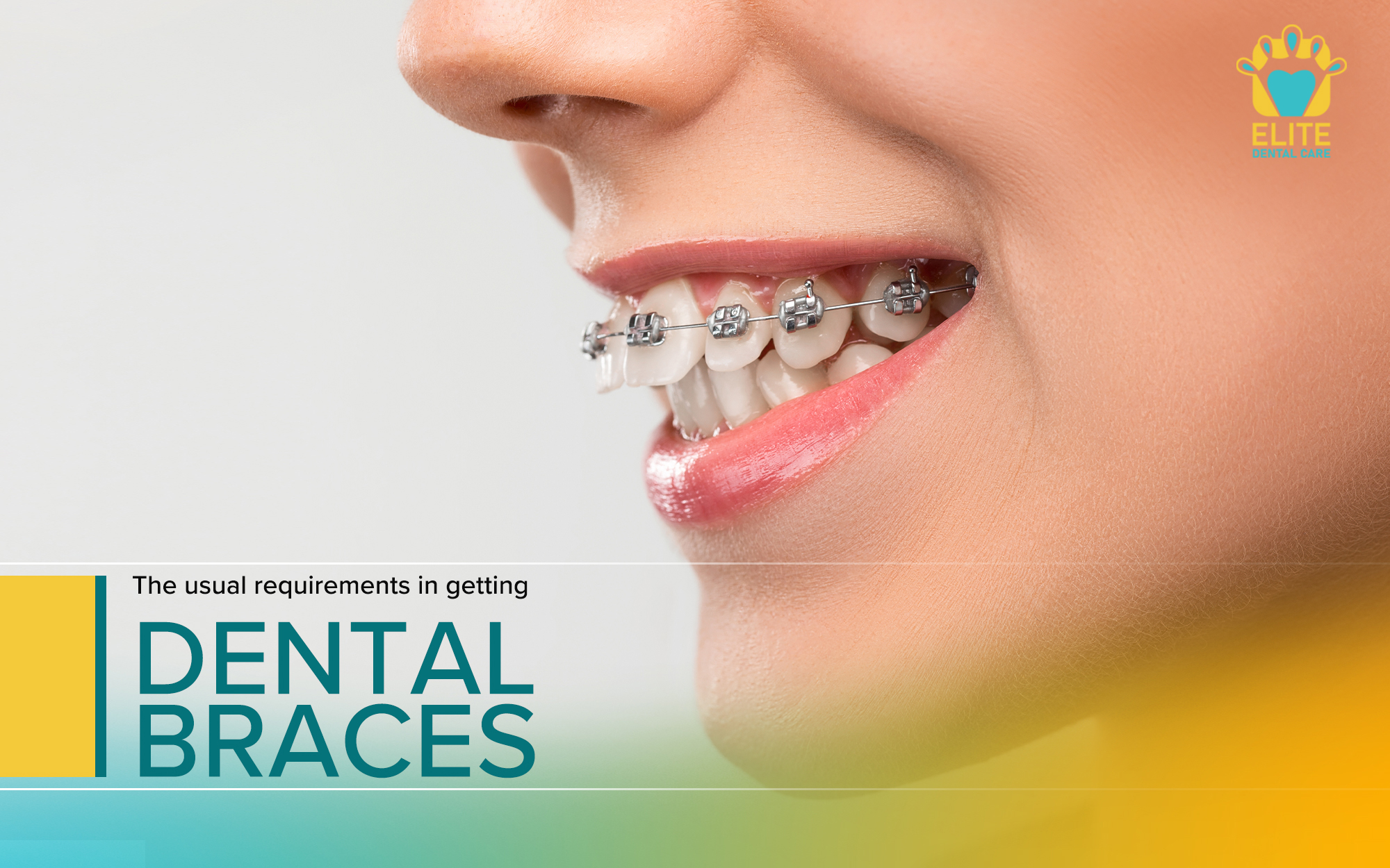 The usual requirements in getting dental braces