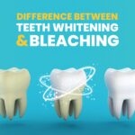 Difference Between Teeth Whitening and Bleaching