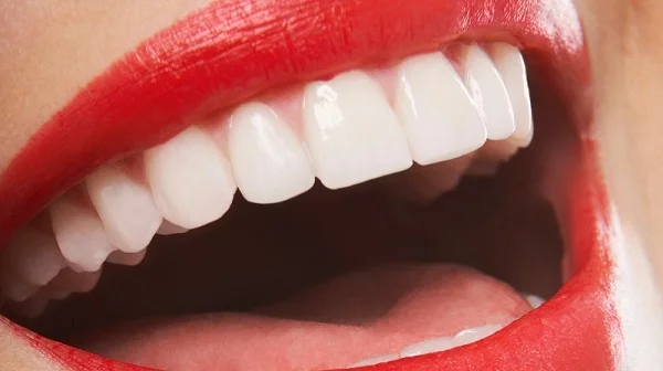Teeth Whitening