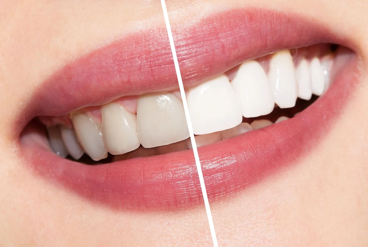 What’s Best for Teeth Whitening