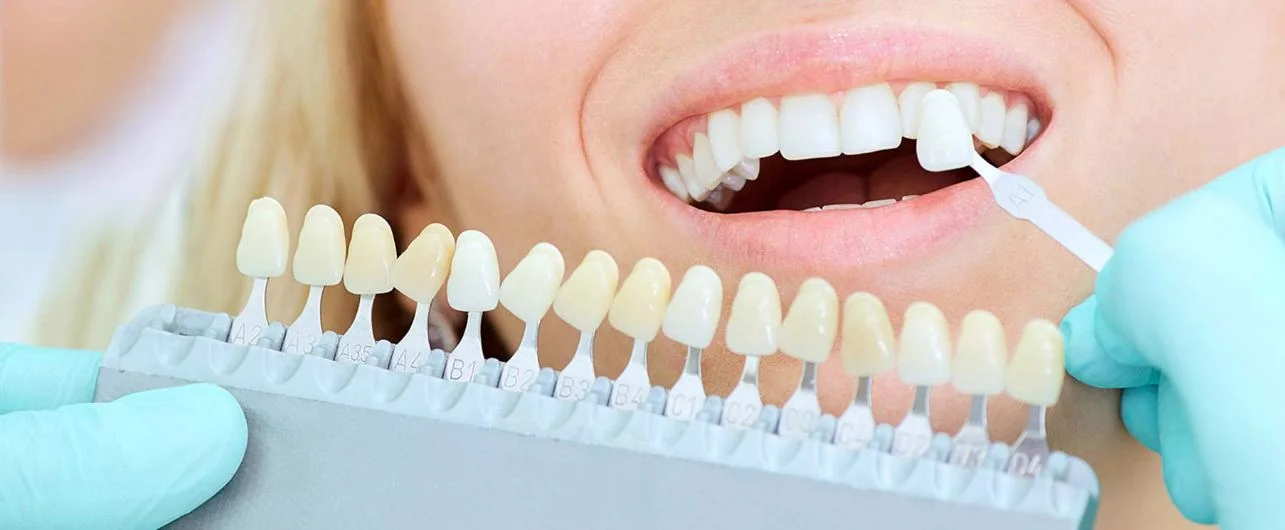 porcelain veneers