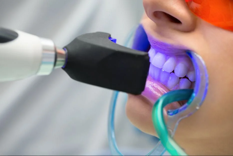 6 Reasons Why You Should Go to a Dentist for Teeth Whitening