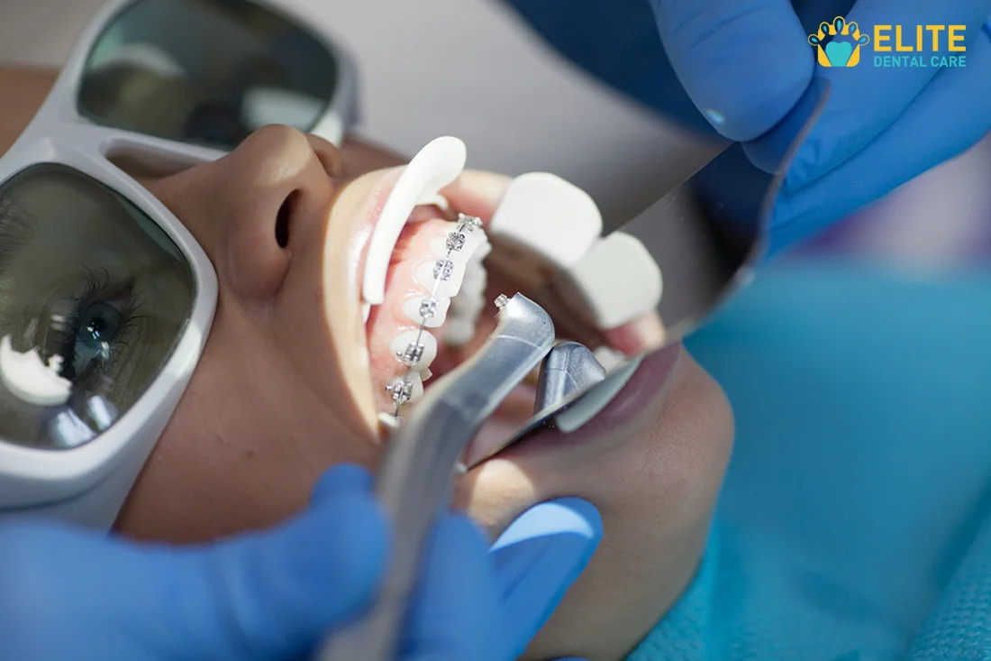 Lasers in Dentistry Tracy CA | Dental Laser – Elite Dental Care Tracy
