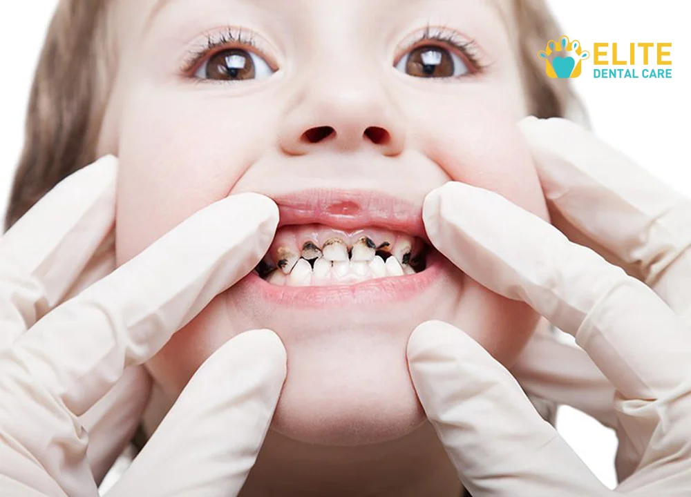 Black Teeth Causes and Treatment to Handle the Problem – Elite Dental Care Tracy