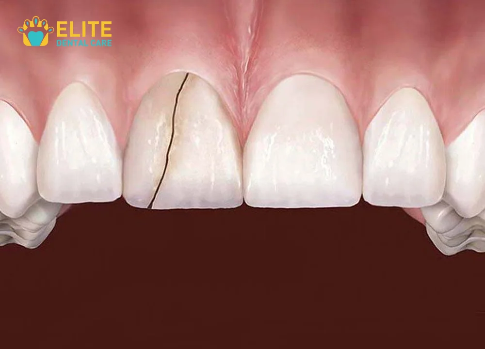 Cracked Tooth Symptoms, Treatments, and Recovery | Endodoncia Tracy