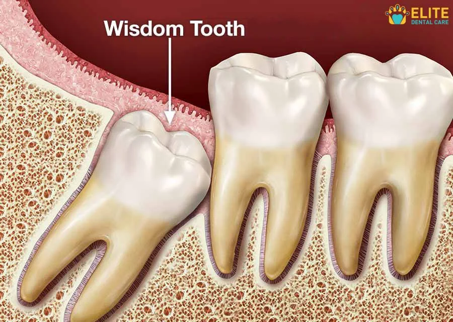 How Are Wisdom Teeth Removed – Elite Dental Care Tracy