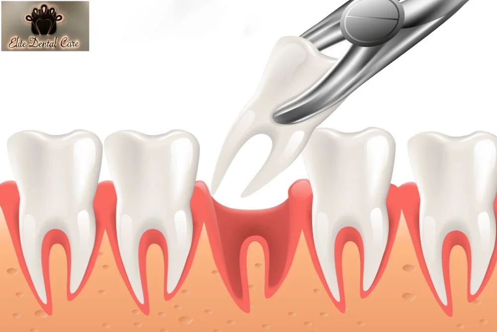 How to Take Care of Your Mouth After a Tooth Extraction – Elite Dental Care Tracy