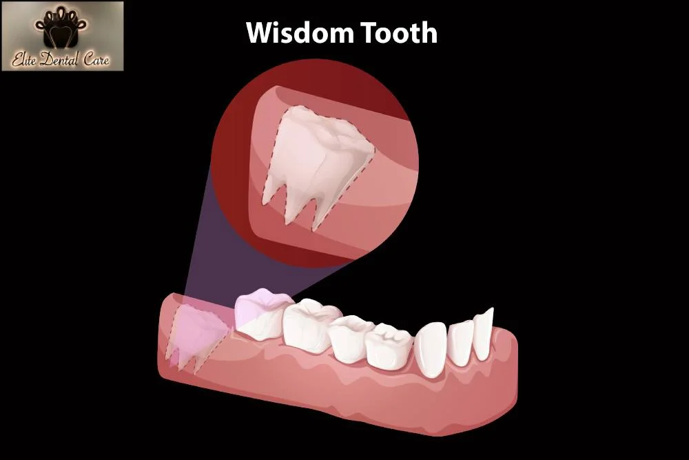 What Happens During Wisdom Teeth Extraction – Elite Dental Care Tracy