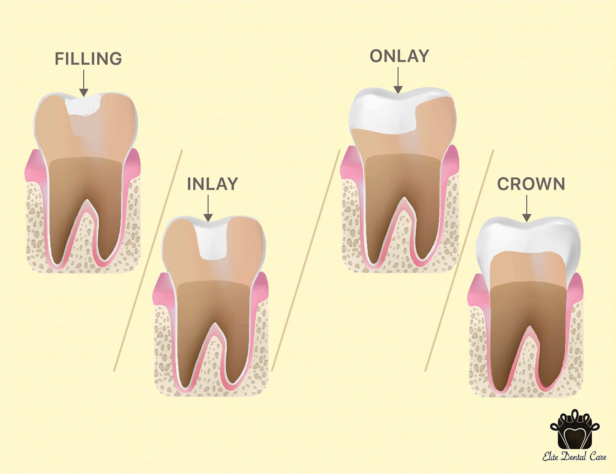 Fillings VS Inlay/Onlay VS Crown – Elite Dental Care Tracy