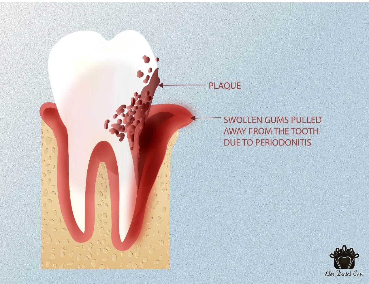 Why is it Important to Treat Periodontitis Disease – Elite Dental Care Tracy