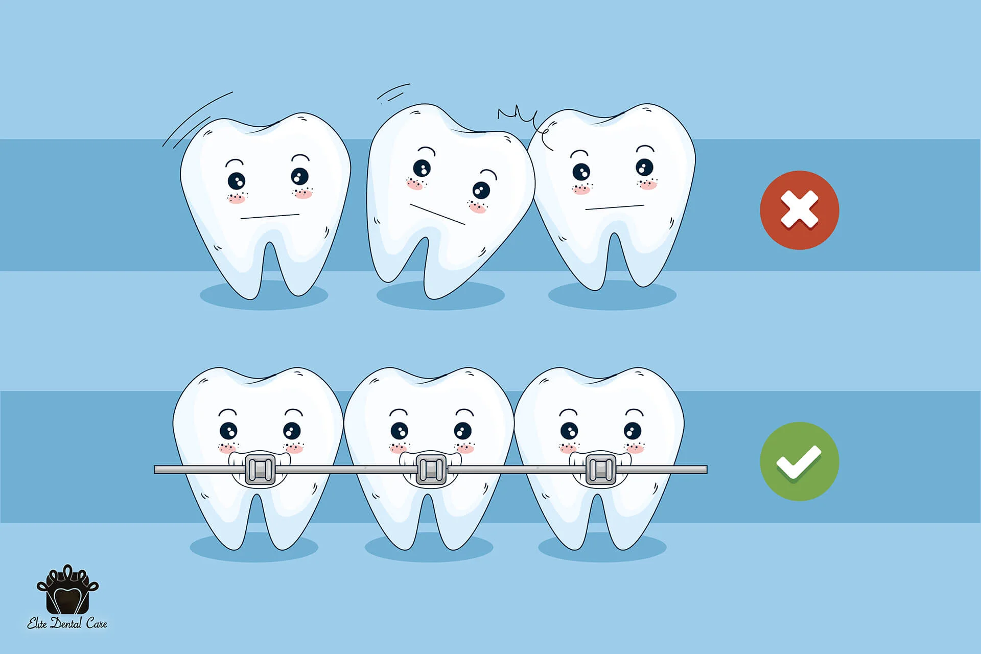 Are You Aware of Braces? Why and Who Puts on Them? – Elite Dental Care Tracy