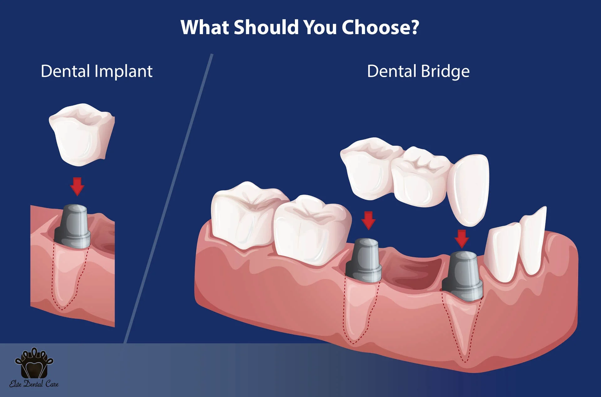 Dental Implants v/s Dental Bridges – Elite Dental Care Tracy