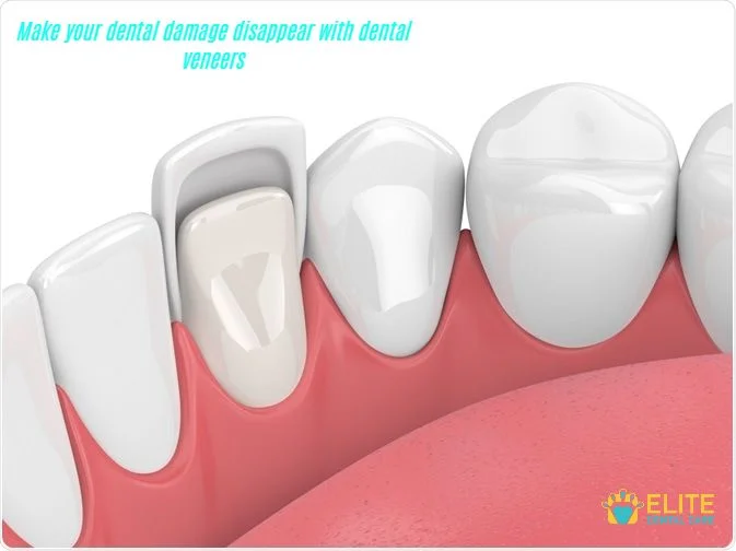 HOW DO DENTAL VENEERS PROTECT FROM THE DENTAL DAMAGE – THE ELITE DENTAL CARE