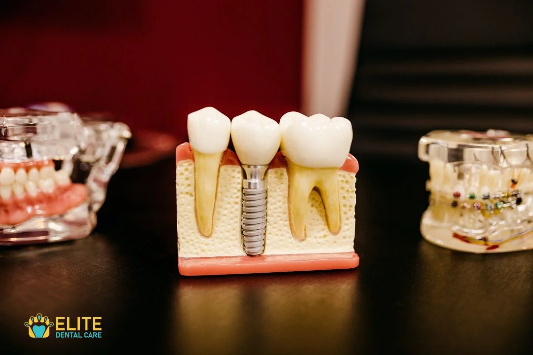 SAVE YOUR TEETH WITH ROOT CANAL TREATMENT – ELITE DENTAL CARE TRACY