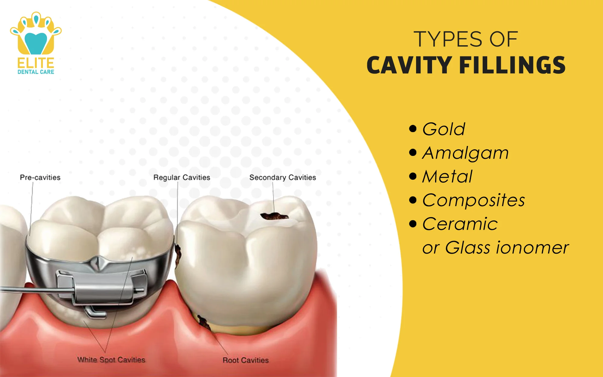 TYPES OF CAVITY FILLINGS – ELITE DENTAL CARE TRACY