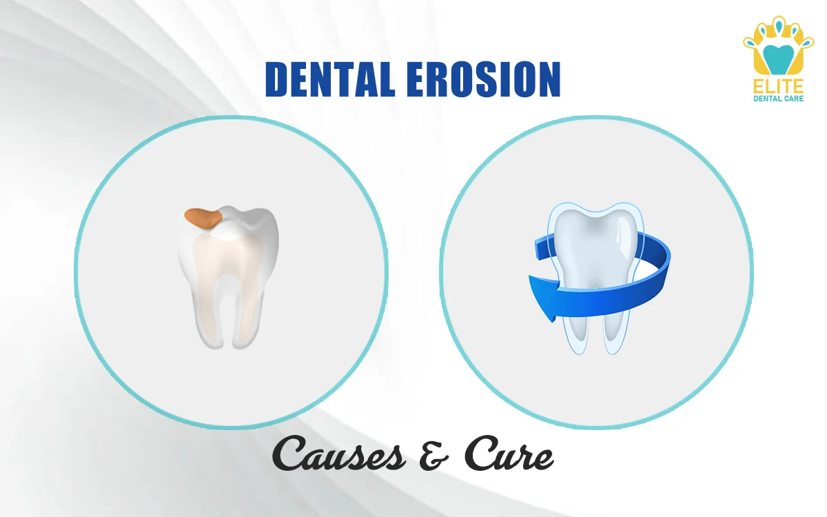 DENTAL EROSION: CAUSES AND CURE – ELITE DENTAL CARE TRACY