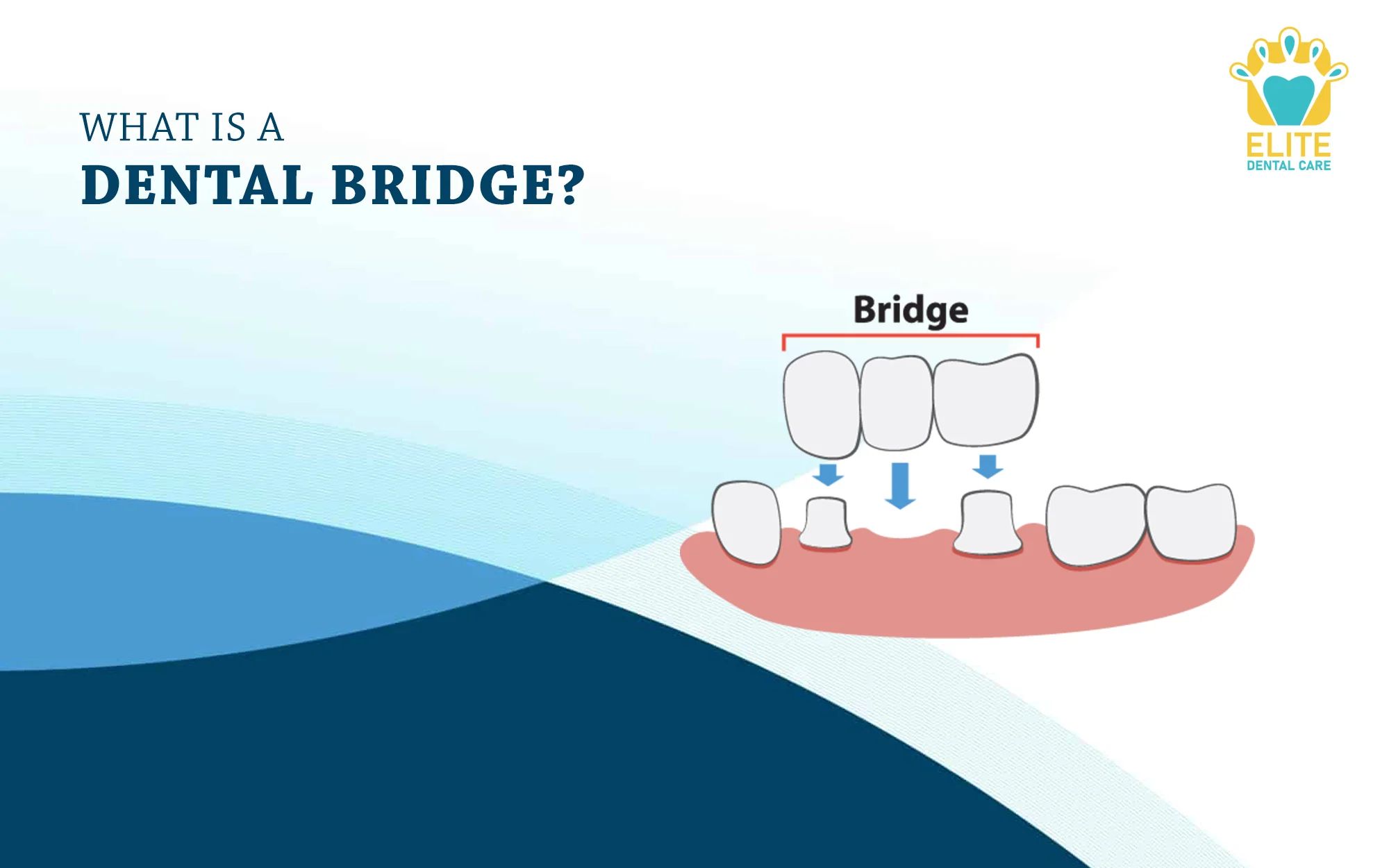 WHAT IS A DENTAL BRIDGE – ELITE DENTAL CARE, TRACY