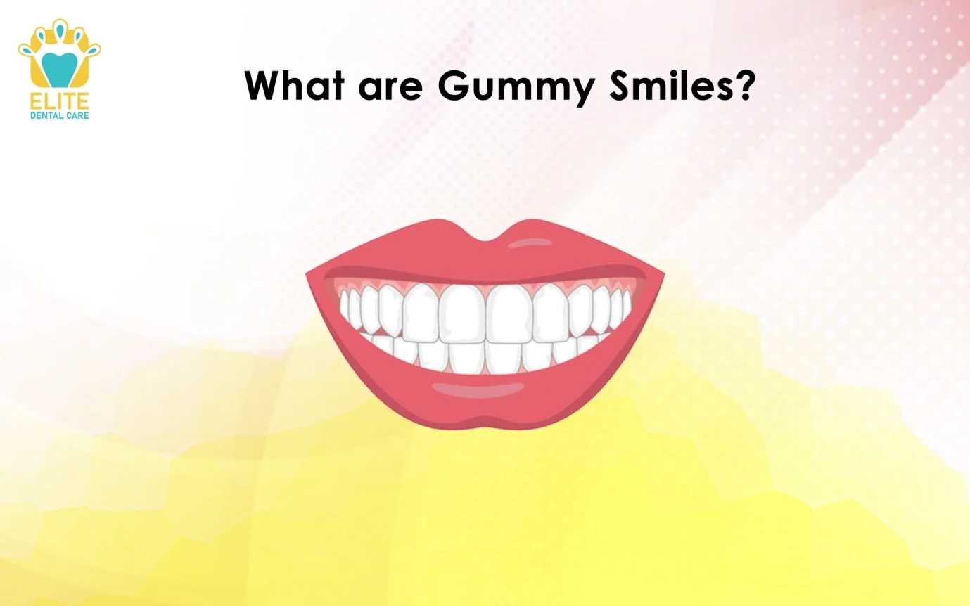 WHAT ARE GUMMY SMILES