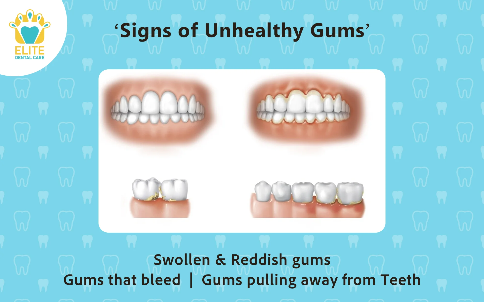 SIGNS OF UNHEALTHY GUMS