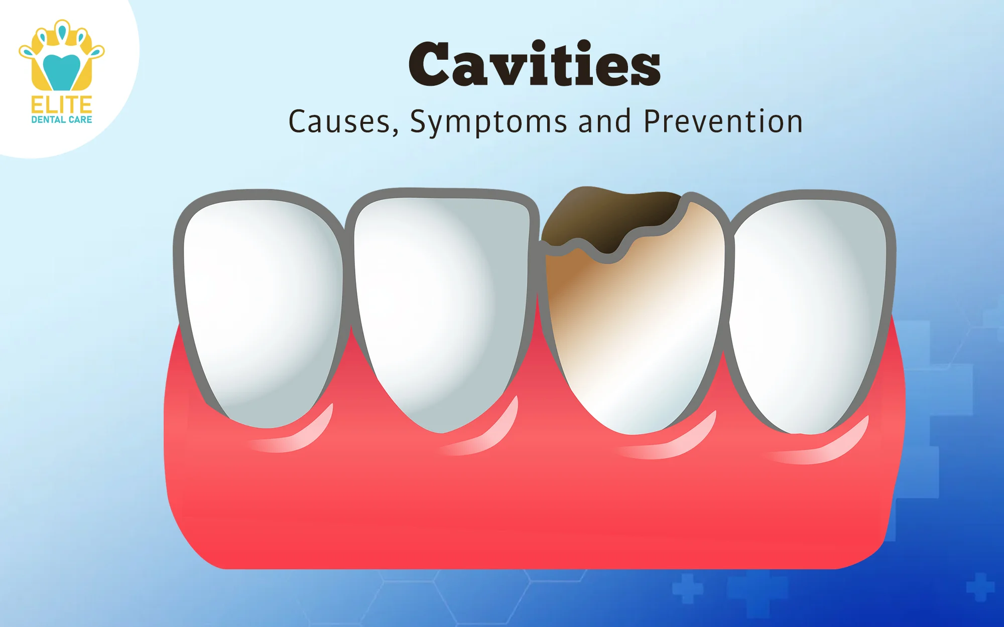 CAVITIES: CAUSES, SYMPTOMS & PREVENTION