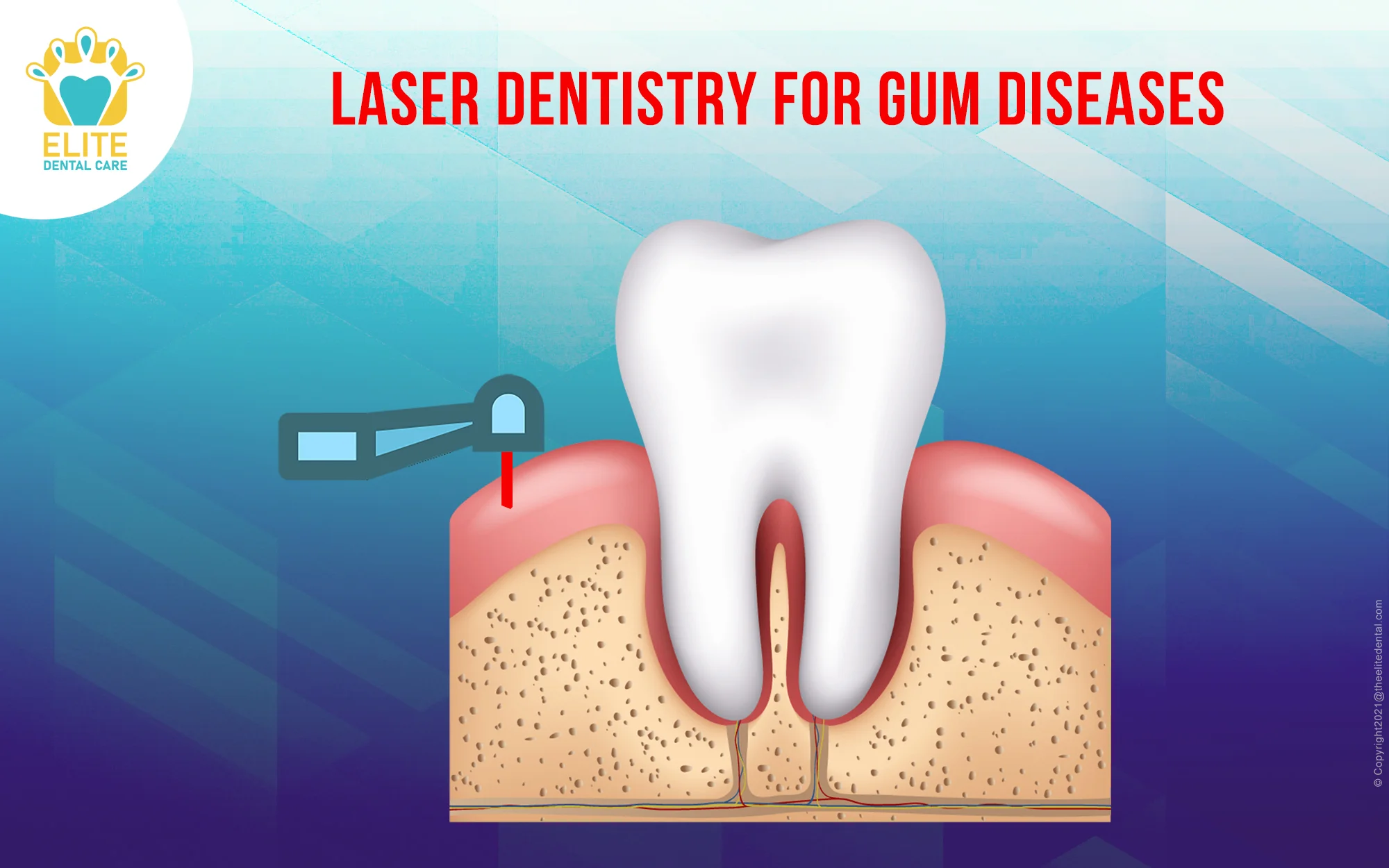 LASER DENTISTRY FOR GUM DISEASES