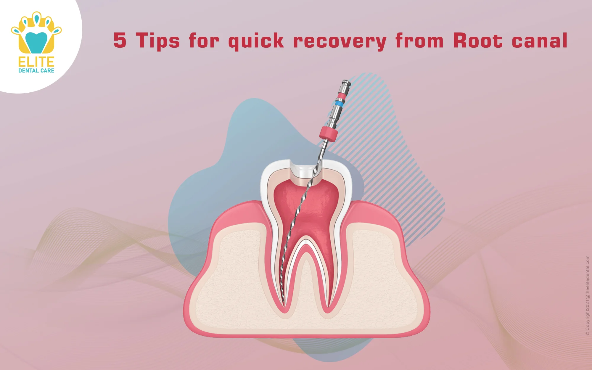 5 TIPS TO SPEED UP ROOT CANAL RECOVERY