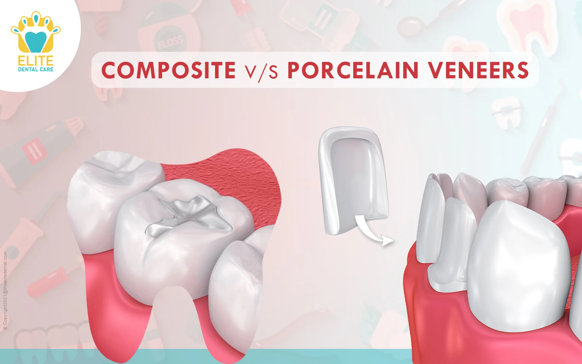 COMPOSITE VS PORCELAIN VENEERS