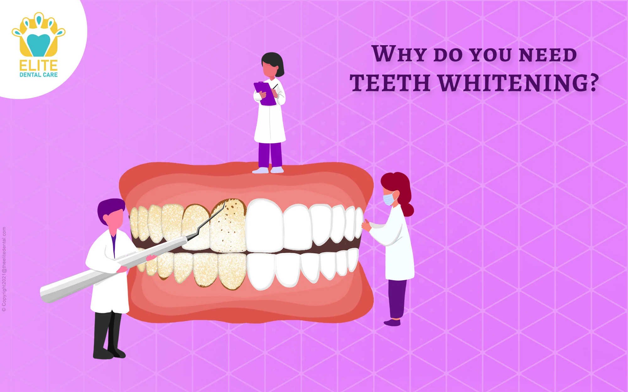 Why do you need teeth whitening?