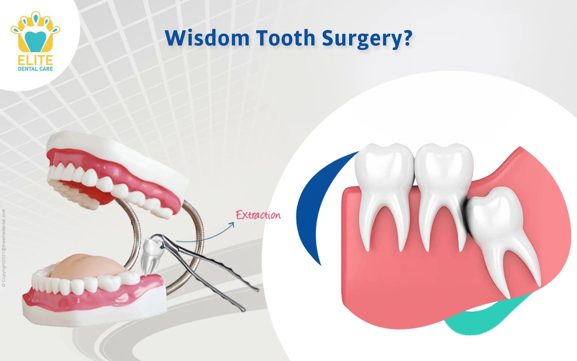 Wisdom Tooth Surgery: Everything You Need to Know!