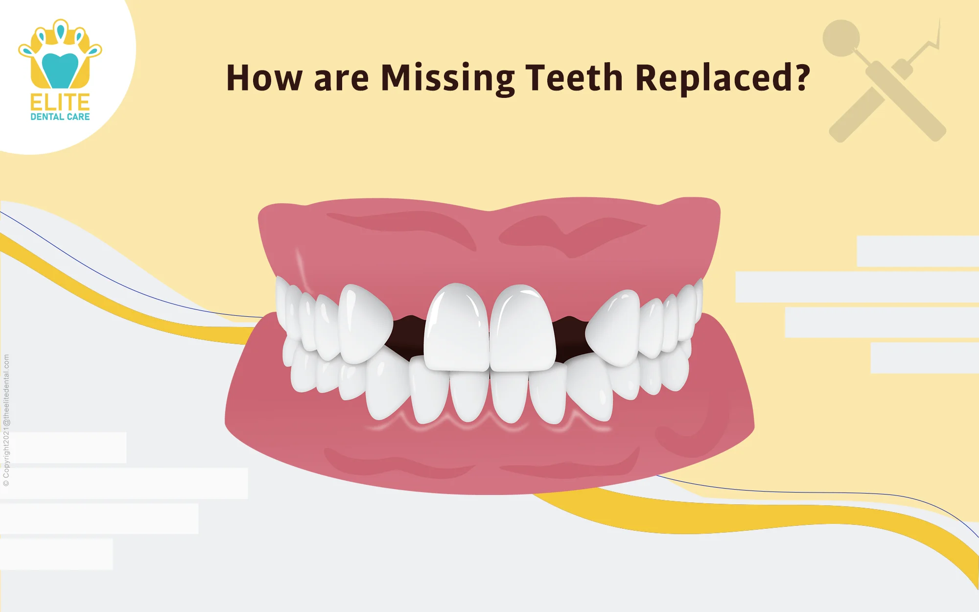 How are missing teeth replaced?