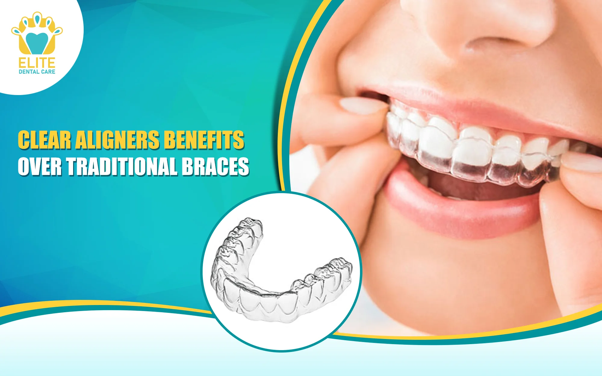 Clear Aligners’ Benefits Over Traditional Braces