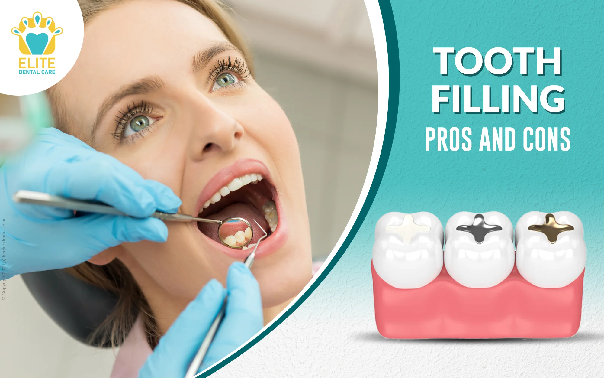 What are the Pros and Cons of Undergoing Dental Tooth Filling?