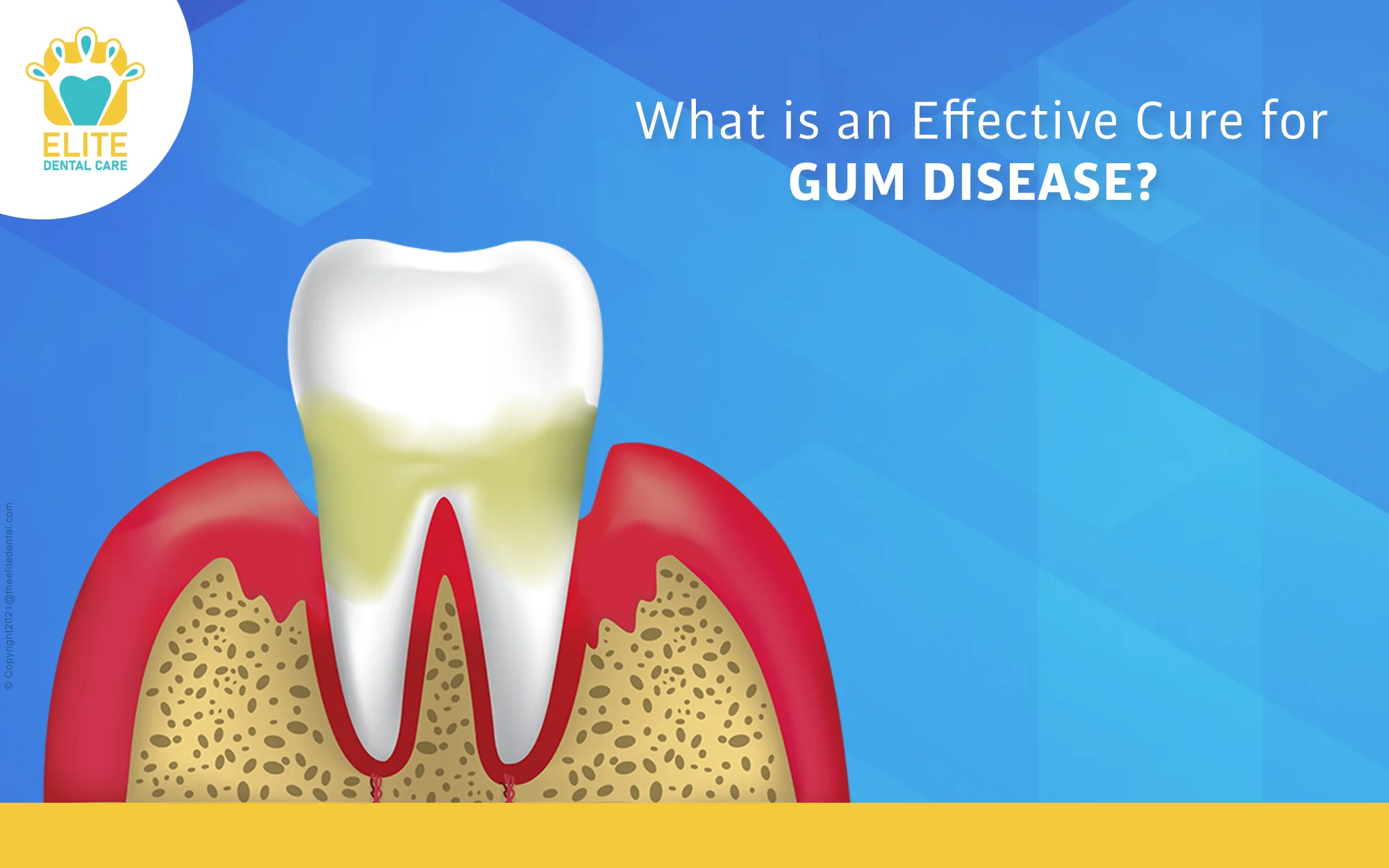 What is an Effective Cure for Gum Disease?