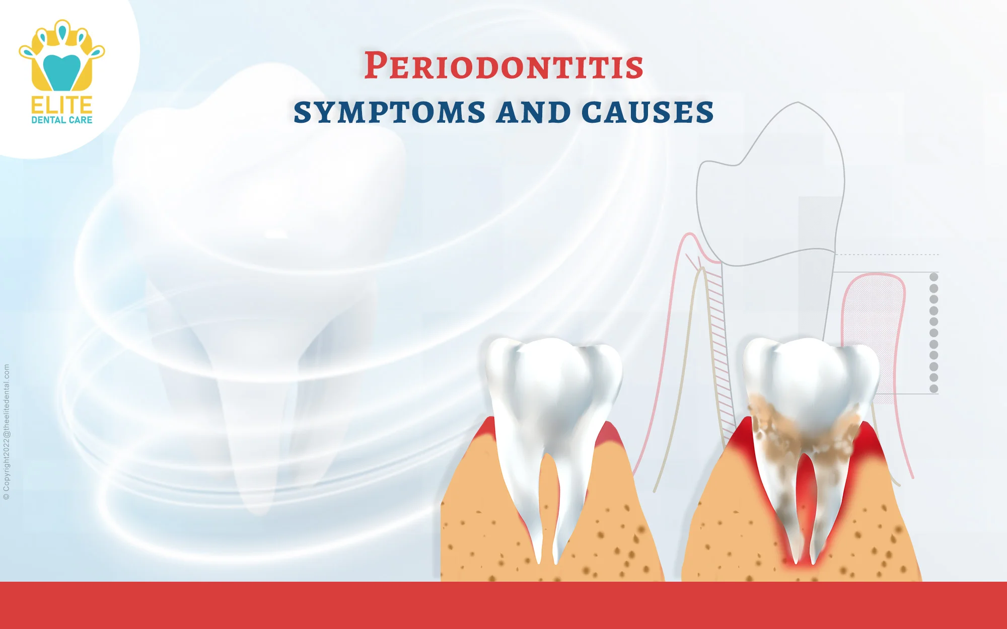Periodontitis and its Symptoms