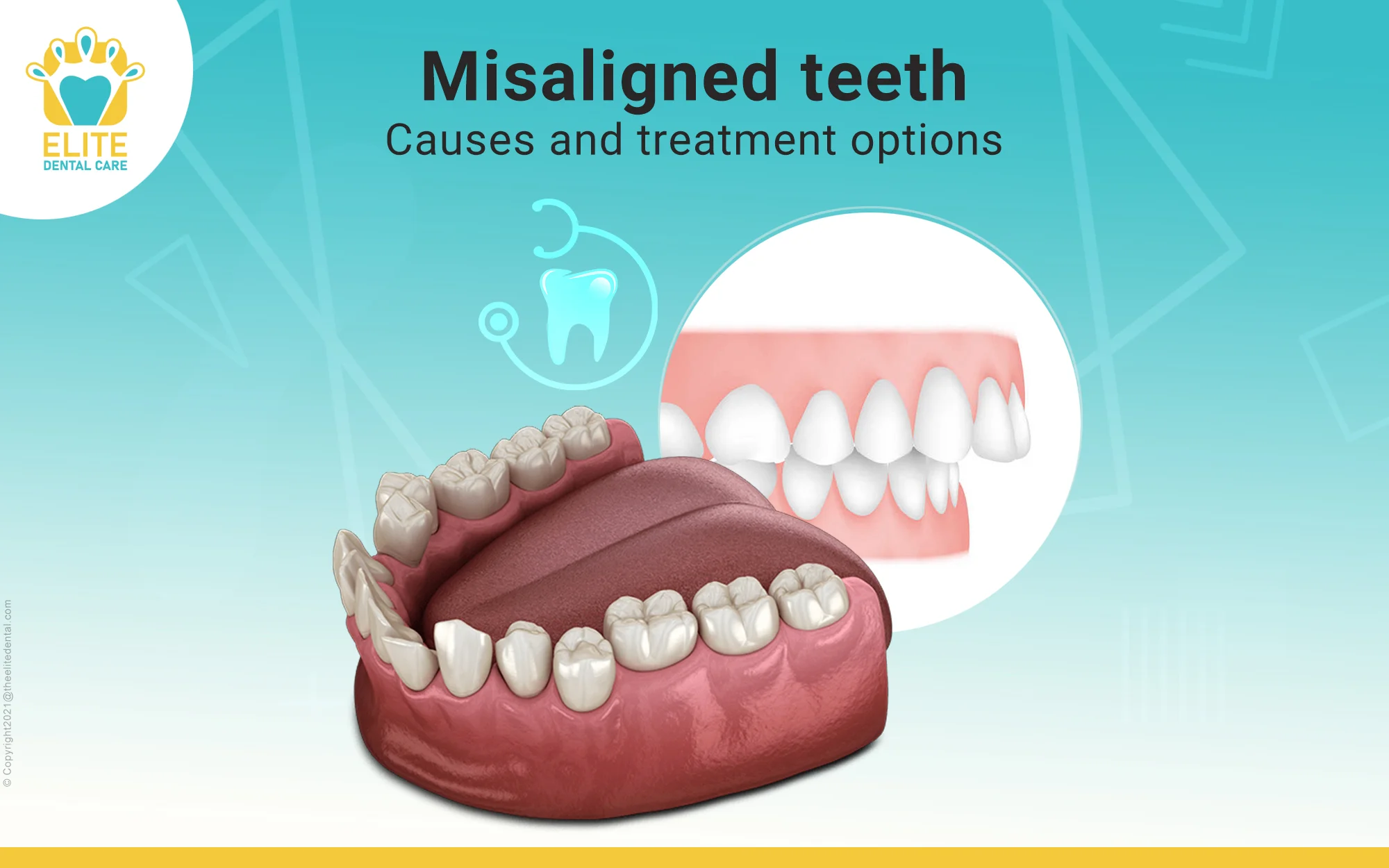 Misaligned Teeth – Causes and Treatment Options