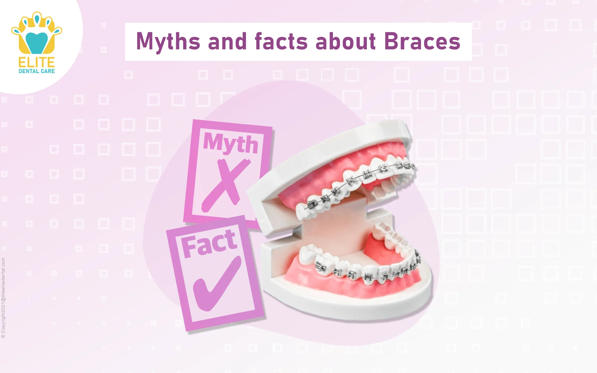 Myths and Facts about Braces