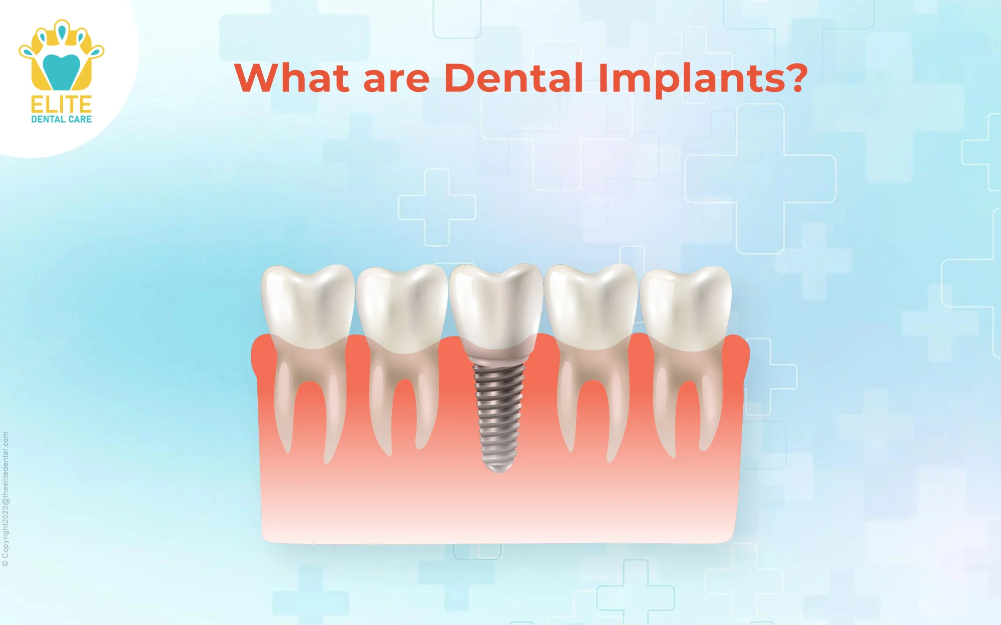 What are Dental Implants?
