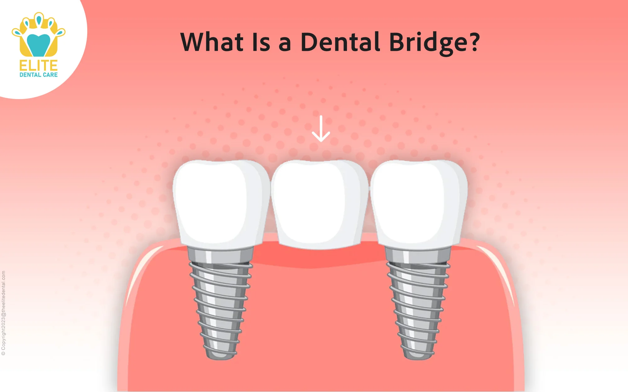 What Is a Dental Bridge?