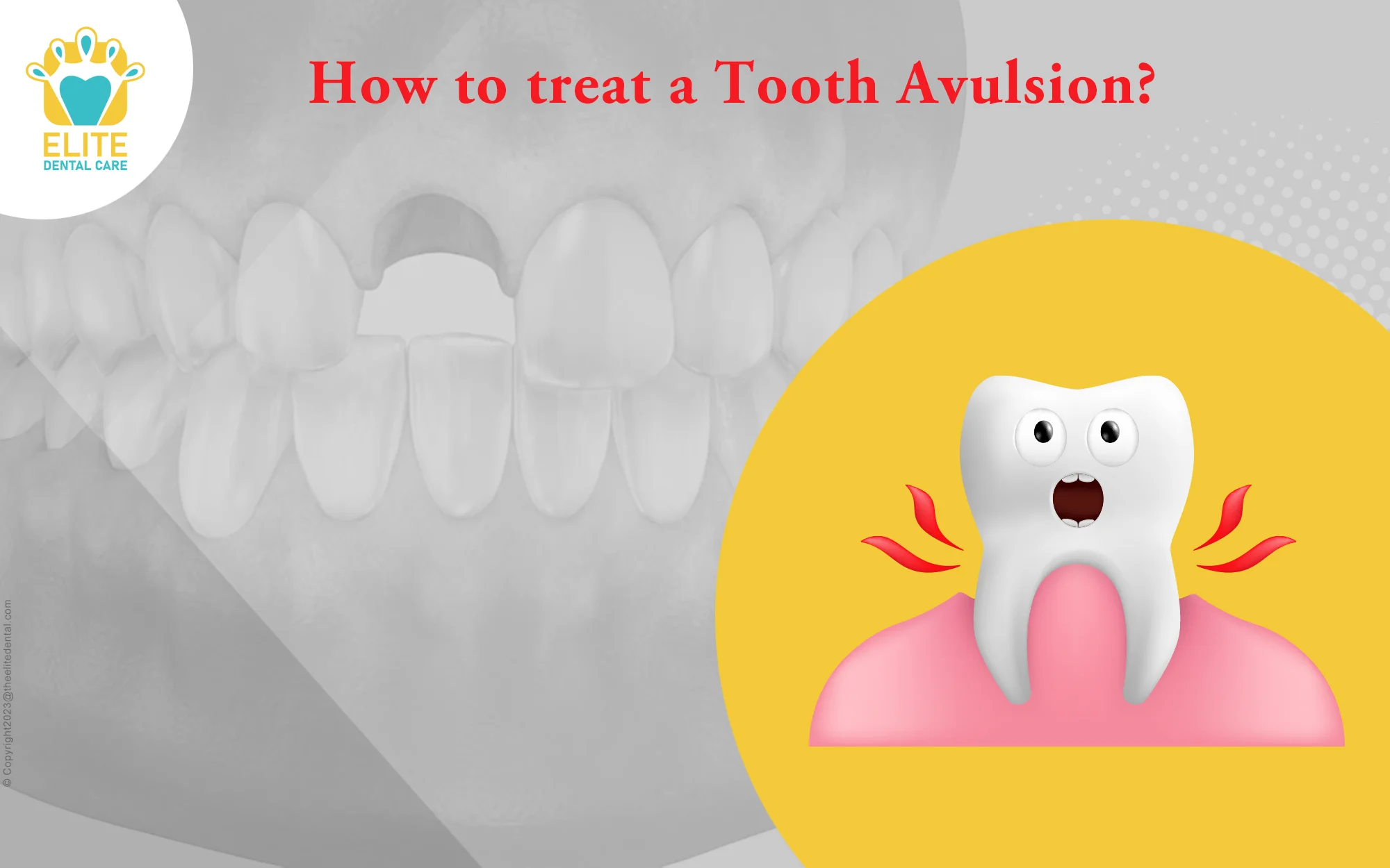 HOW TO TREAT A TOOTH AVULSION